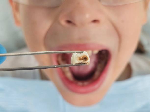 Best Urgent Care for Lost Fillings or Crowns in Oak View, CA